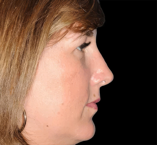 Side profile of the same patient after her procedure