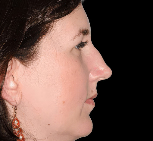 Side profile of a patient before her procedure