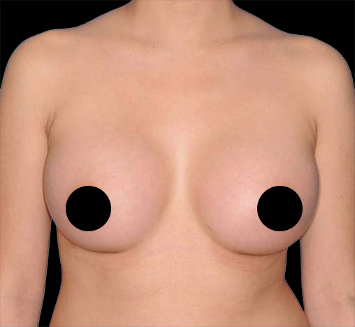 Chest of the same patient after her breast procedure