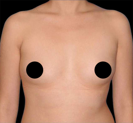 Chest of a patient before her breast procedure