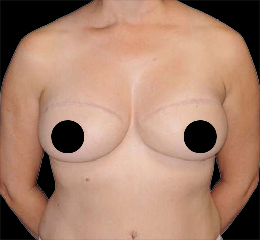 Chest of the same patient after her breast reconstruction