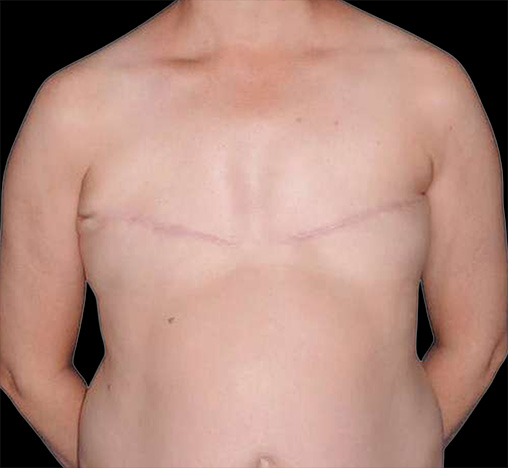 Chest of a patient before her breast reconstruction