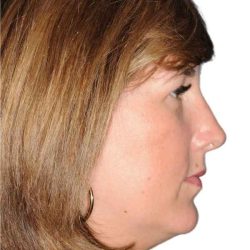 Rhinoplasty Before & After Patient #418