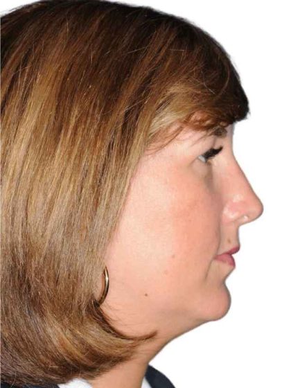 Rhinoplasty Before & After Patient #418