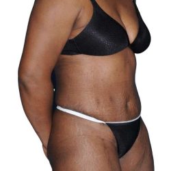 Tummy Tuck Before & After Patient #478