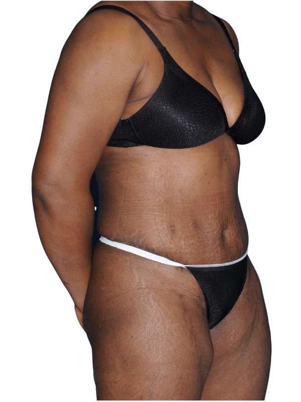 Tummy Tuck Before & After Patient #478