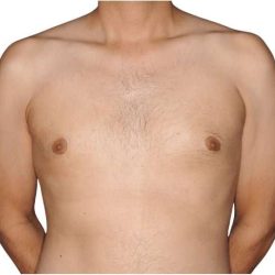 Gynecomastia Before & After Patient #515