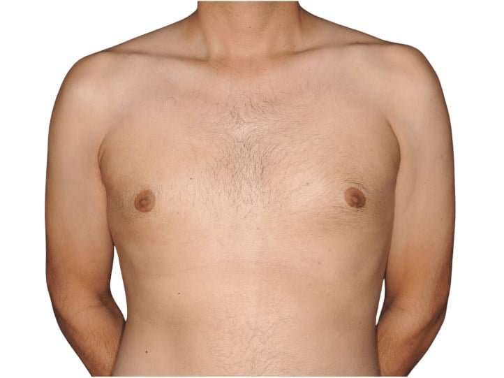Gynecomastia Before & After Patient #515
