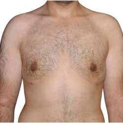 Gynecomastia Before & After Patient #525