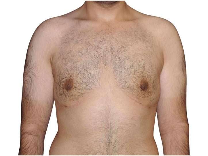 Gynecomastia Before & After Patient #525