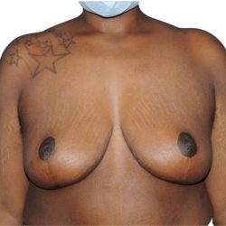 Breast Lift Before & After Patient #538