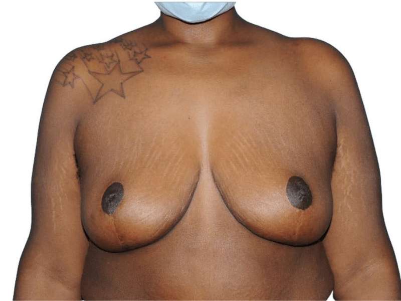 Breast Lift Before & After Patient #538