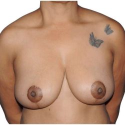 Breast Lift Before & After Patient #552