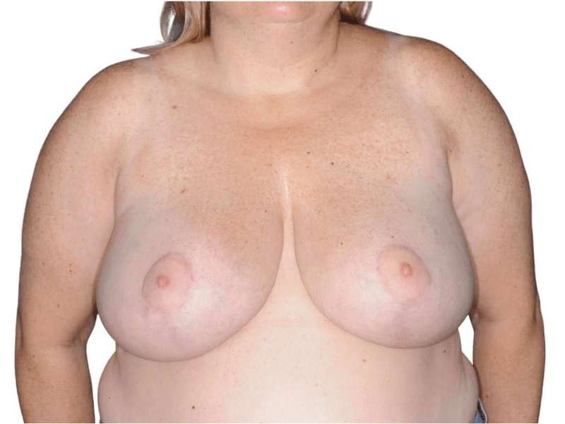 Breast Reduction Before & After Patient #579