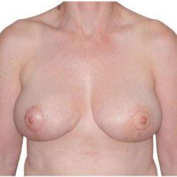 Breast Reduction Before & After Patient #586