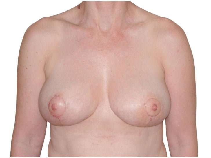 Breast Reduction Before & After Patient #586