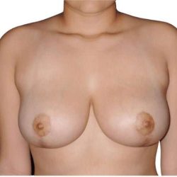 Breast Reduction Before & After Patient #593