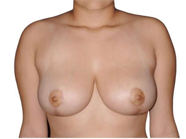 Breast Reduction Before & After Patient #593