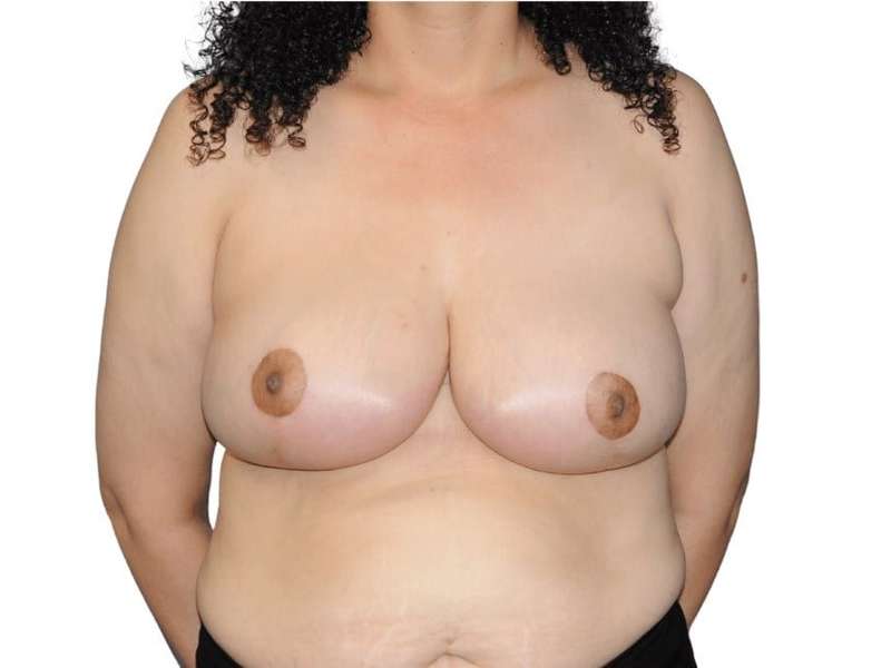 Breast Reduction Before & After Patient #601
