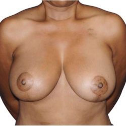 Breast Reduction Before & After Patient #630