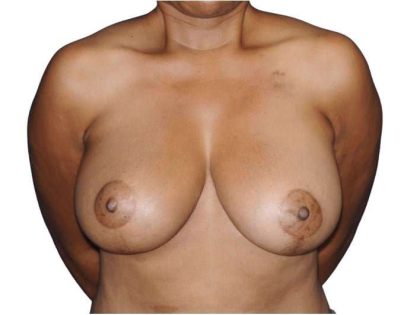 Breast Reduction Before & After Patient #630