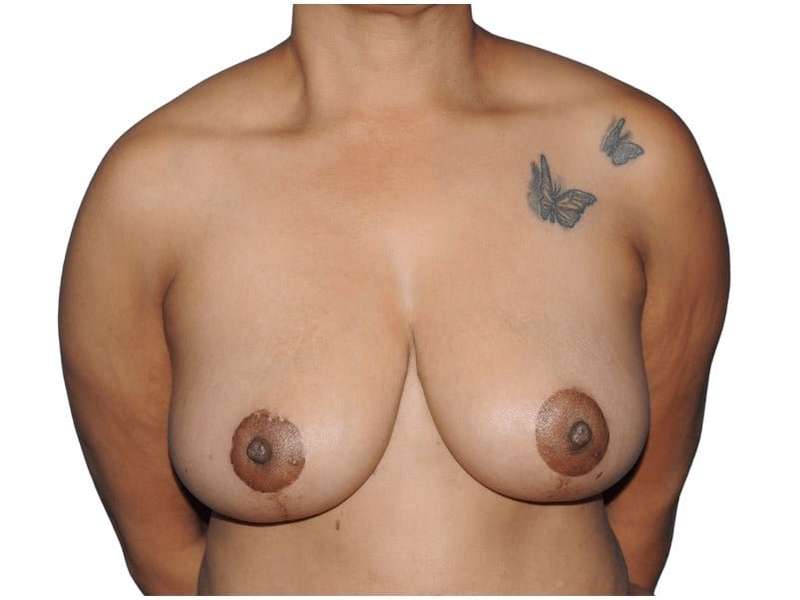 Breast Reduction Before & After Patient #635