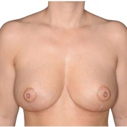 Breast Reduction Before & After Patient #649