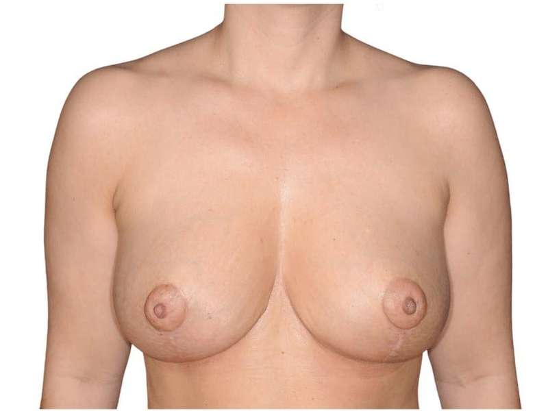 Breast Reduction Before & After Patient #649