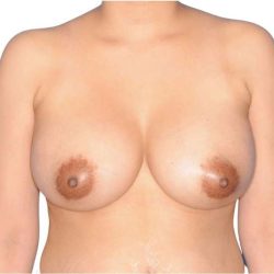 Breast Augmentation Before & After Patient #656