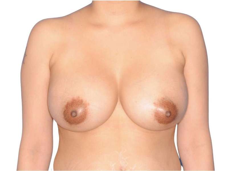 Breast Augmentation Before & After Patient #656