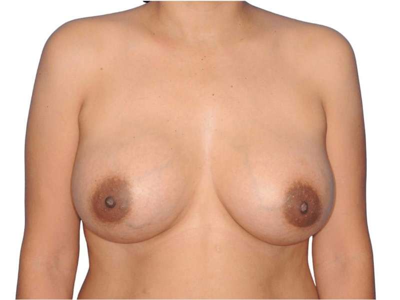 Breast Augmentation Before & After Patient #663