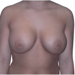 Breast Augmentation Before & After Patient #670