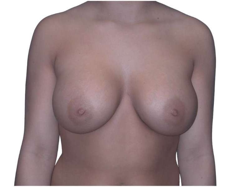 Breast Augmentation Before & After Patient #670