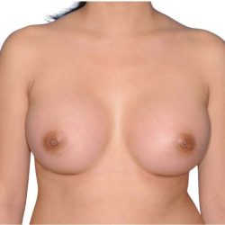 Breast Augmentation Before & After Patient #679