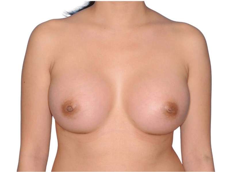 Breast Augmentation Before & After Patient #679