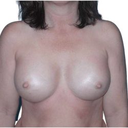 Breast Augmentation Before & After Patient #686
