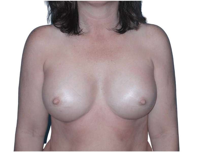Breast Augmentation Before & After Patient #686