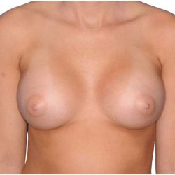 Breast Augmentation Before & After Patient #693
