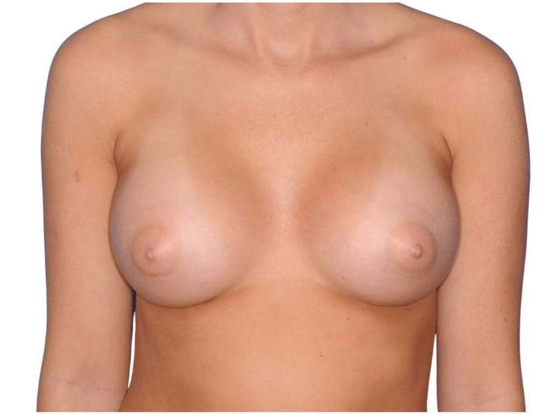 Breast Augmentation Before & After Patient #693