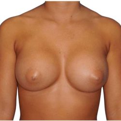 Breast Augmentation Before & After Patient #700