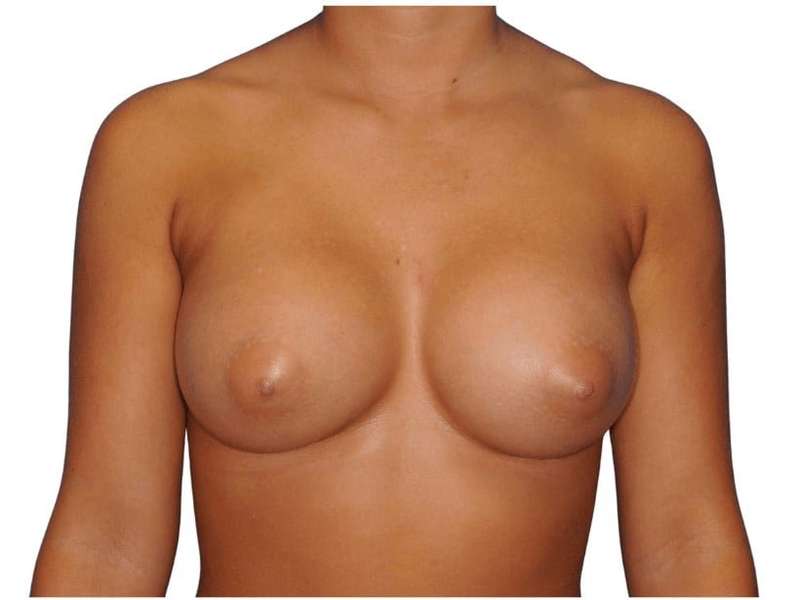 Breast Augmentation Before & After Patient #700