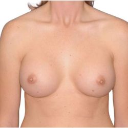 Breast Augmentation Before & After Patient #707