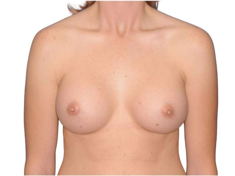 Breast Augmentation Before & After Patient #707