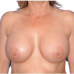 Breast Augmentation Before & After Patient #714