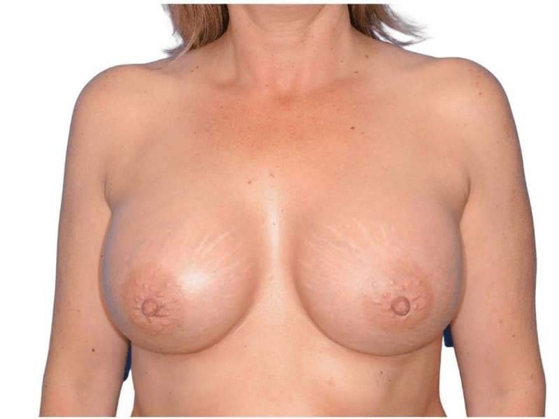 Breast Augmentation Before & After Patient #714