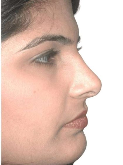 Rhinoplasty Before & After Patient #409