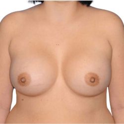 Breast Augmentation Before & After Patient #721