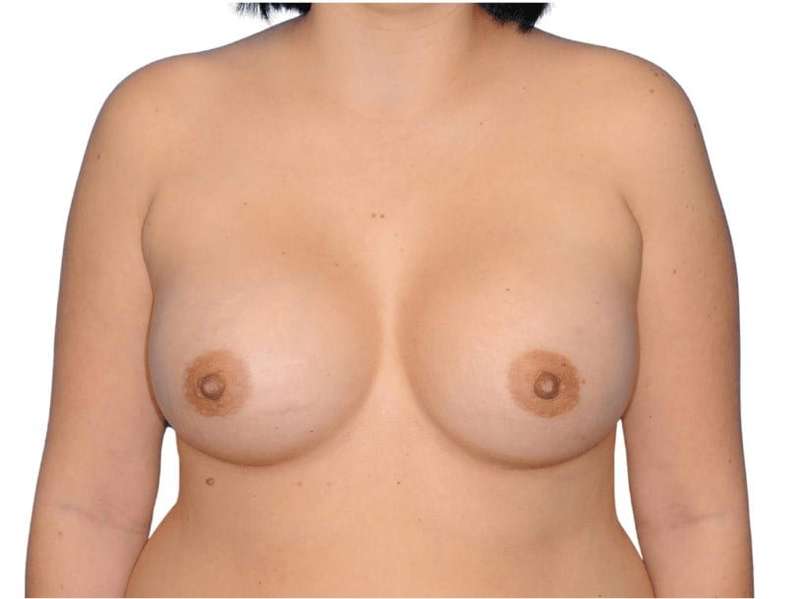 Breast Augmentation Before & After Patient #721