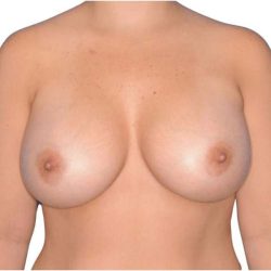 Breast Augmentation Before & After Patient #726