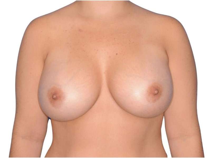 Breast Augmentation Before & After Patient #726